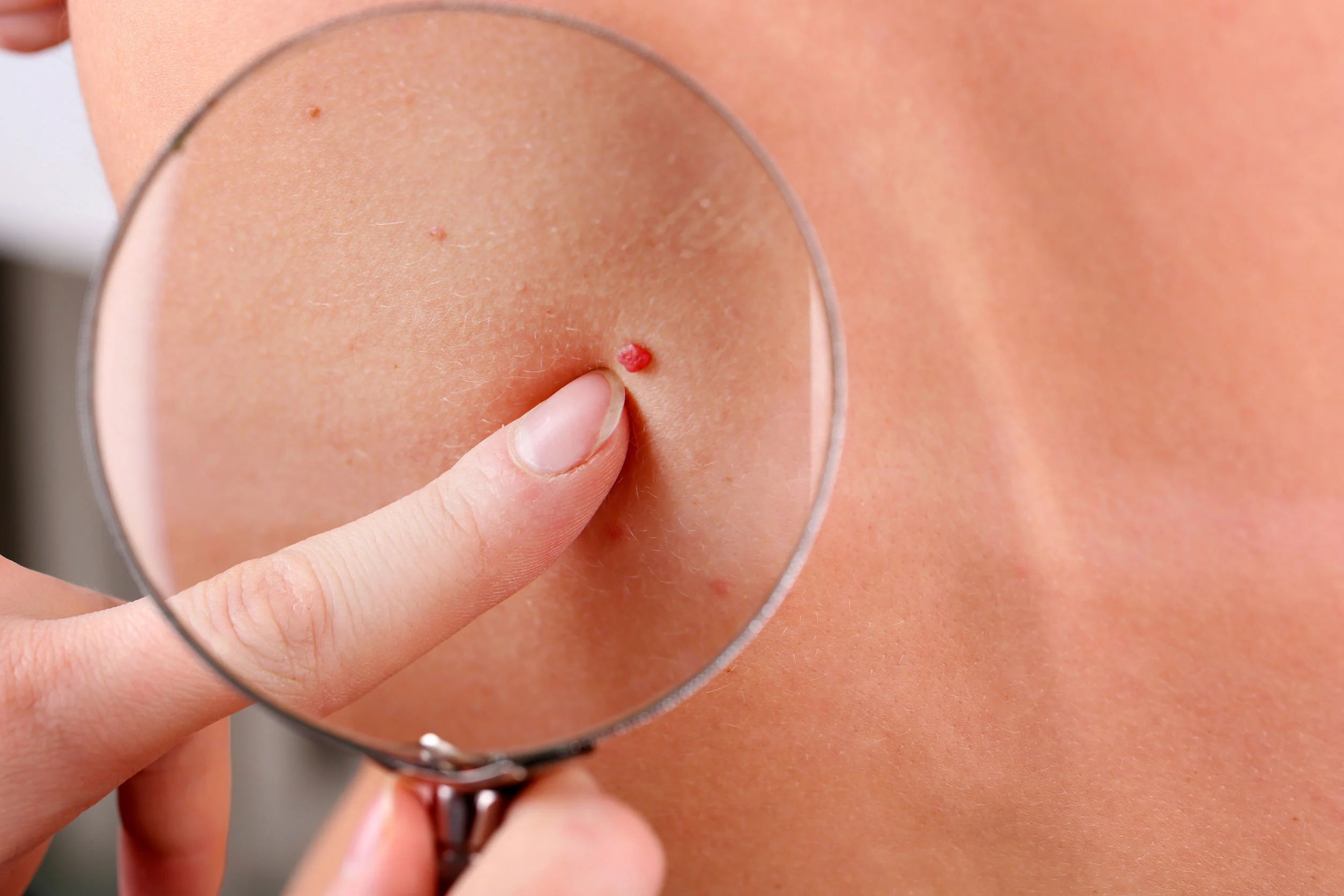 Understanding Angiomas: Causes, Types, and Health Implications